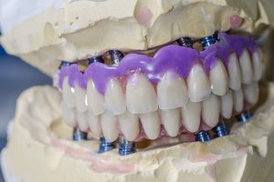Dental Implants Ottawa