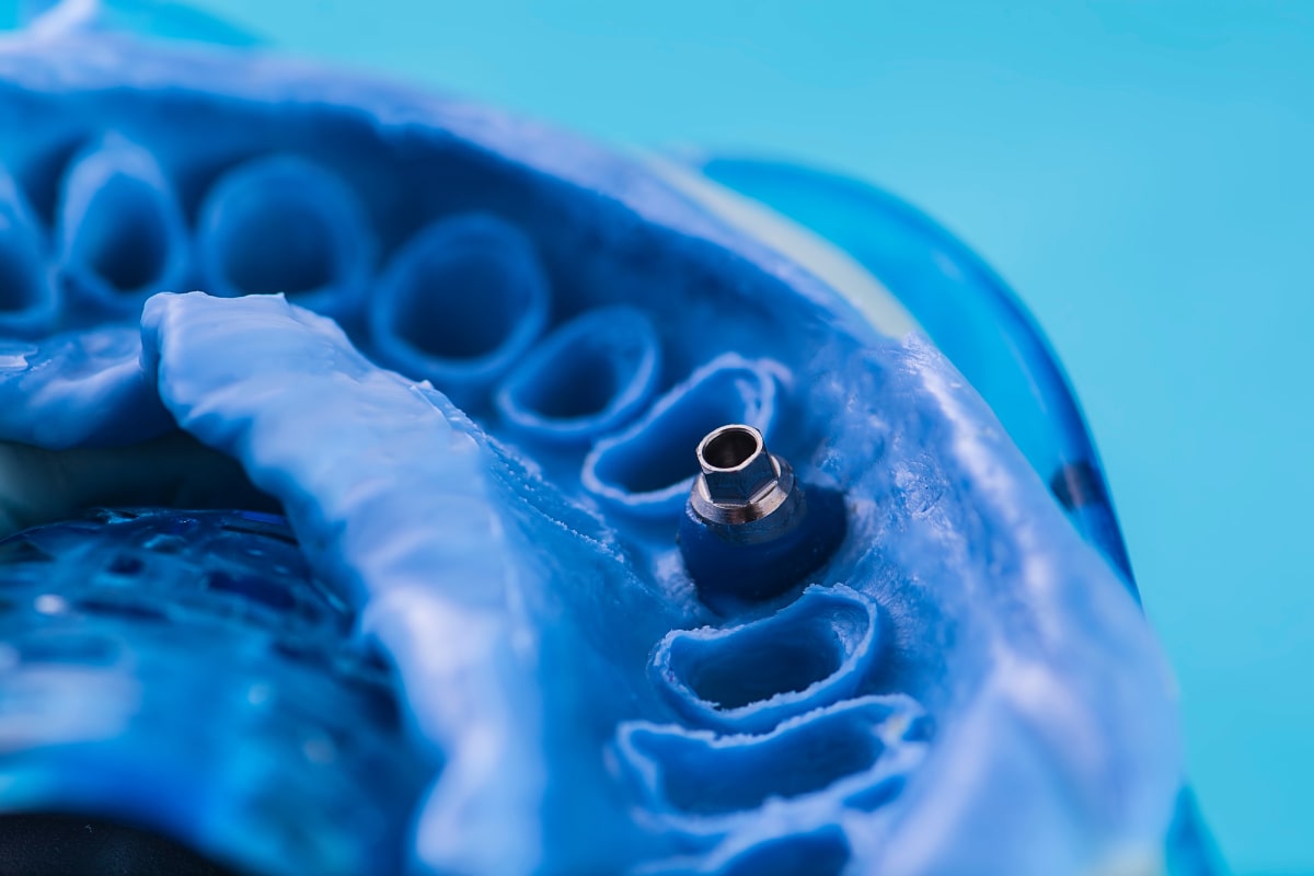 Open Tray vs. Closed Tray Impressions Implant Impression Techniques